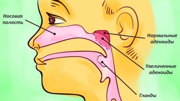 Aденоидит
