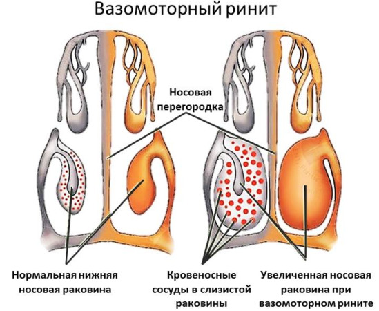 Вазомоторный ринит
