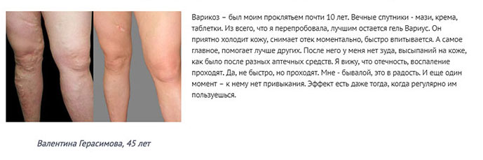 Уникальный гель Вариус – незаменимое средство при варикозе