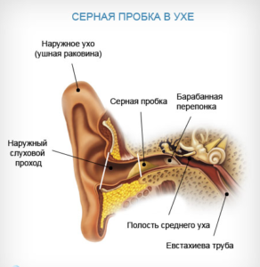 Серная пробка в ухе ребенка