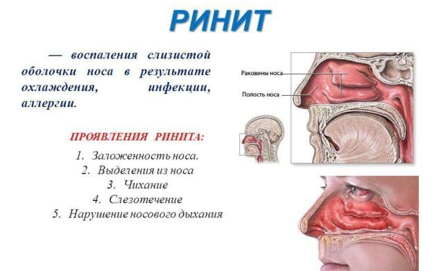 Ринит