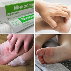 Микоспор — эффективные препараты от грибка ногтей