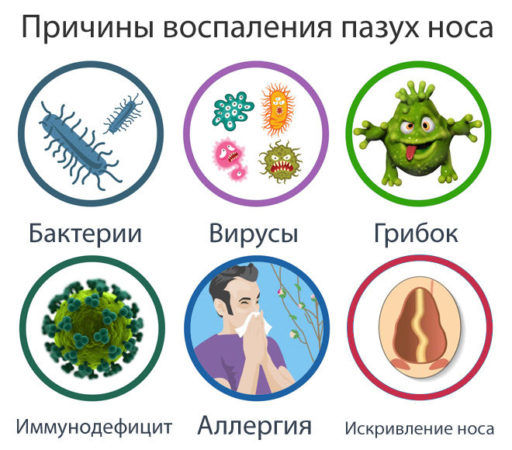 Инфекции пазух носа