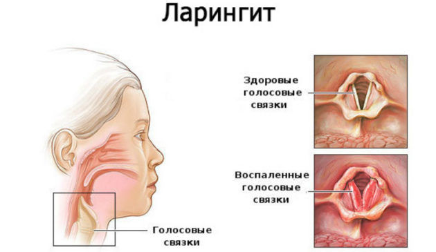 Ларингит