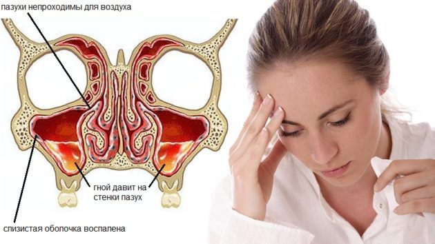 Хроническая форма гайморита