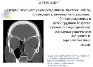 Этмоидит
