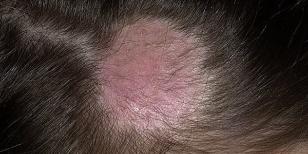 Эффективность Кето Плюс в лечении себорейного и атопического дерматита