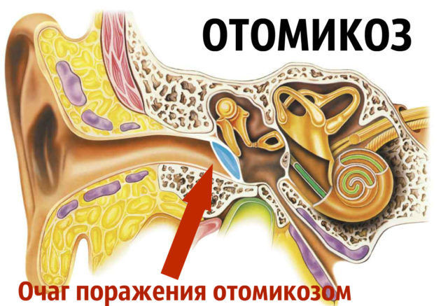 Очаг поражения отомикозом