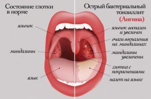 Бактериальная ангина