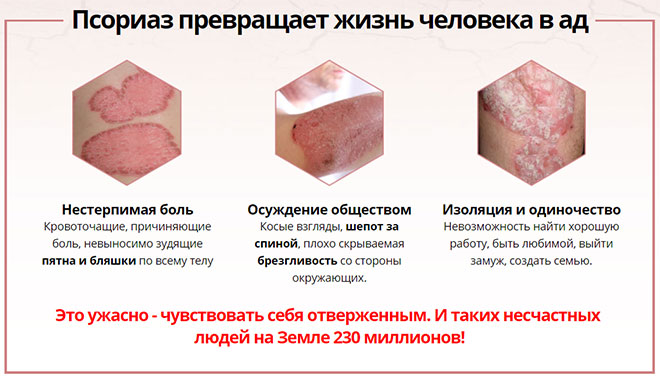 Inderma — эффективное средство от псориаза