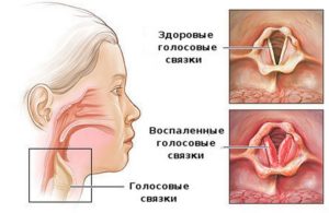 Ларинготрахеит