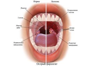 Cимптомы фарингита