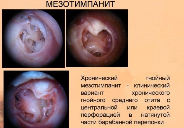 Мезотимпанит