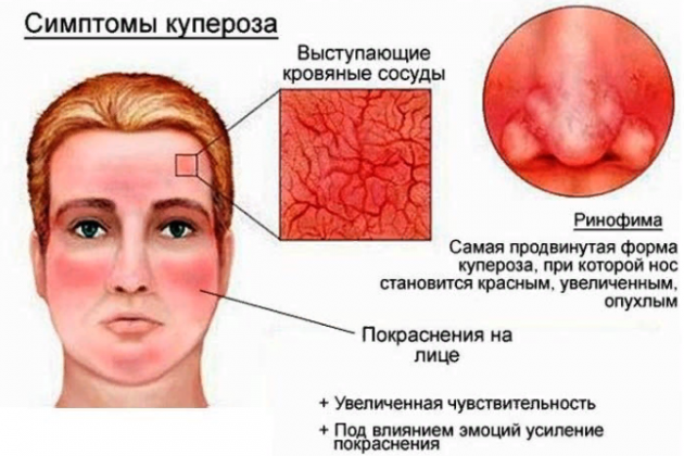 Причины купероза на носу
