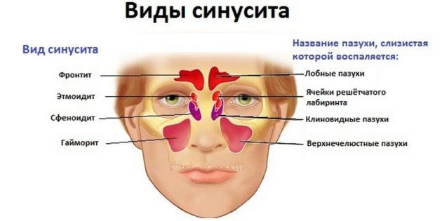 Синусит