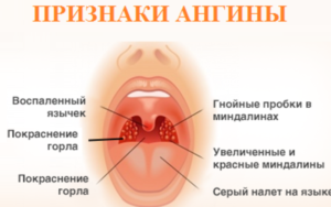 Вирусная ангина