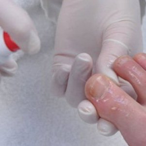 Спреи от грибка на коже и ногтях: обзор и сравнение препаратов