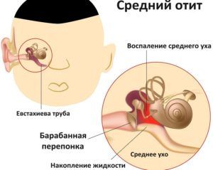 Отит, схема