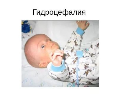 Гидроцефалия