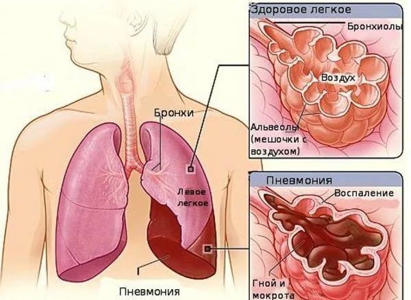 Развитие пневмонии