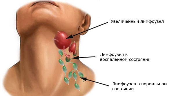 Воспаление лимфоузлов