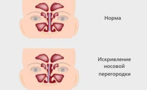 Искривление перегородки носа как одна из причин операции
