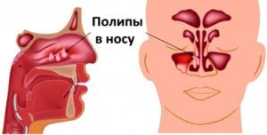 Полипы в носу