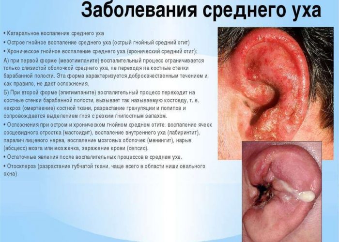 Катаральный отит Катаральный отит