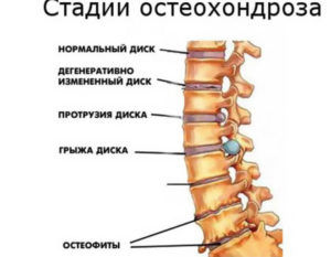 Остеохондроз