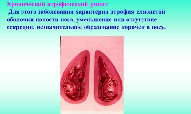 Хронический ринит