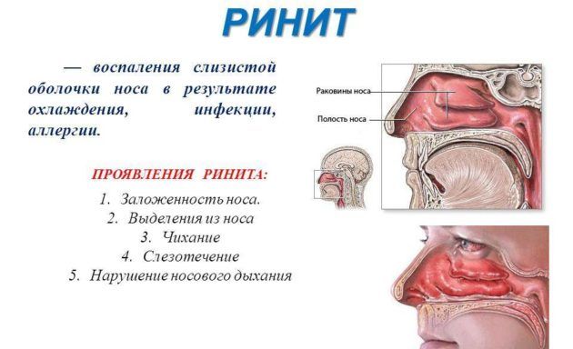 Ринит