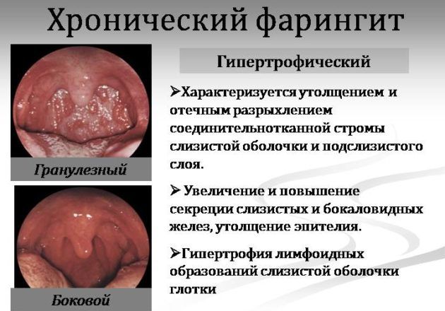 Гипертрофический фарингит