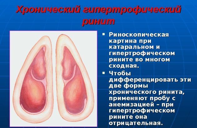 Гипертрофический ринит