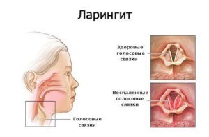 Ларингит