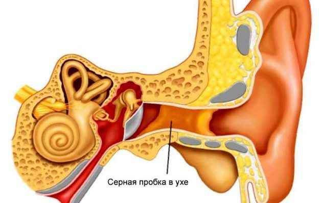 Серная пробка в ухе