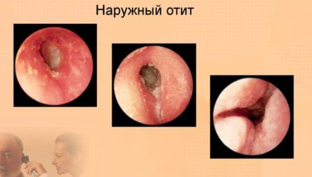 Наружный отит