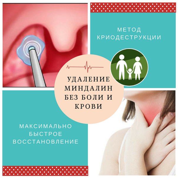 Один из методов удаления миндалин