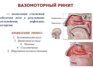 Вазомоторный ринит