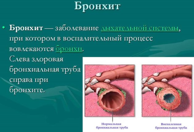 Бронхит