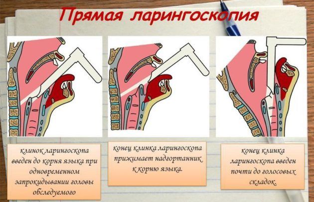 Ларингоскопия