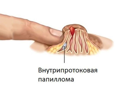 Причины и лечение папилломатозных образований в протоках молочной железы