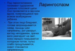 Ларингоспазм
