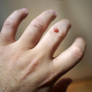 ✋Причины появления и методы лечения папиллом на руках