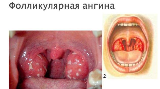 Фолликулярная ангина