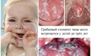 Грибковый стоматит