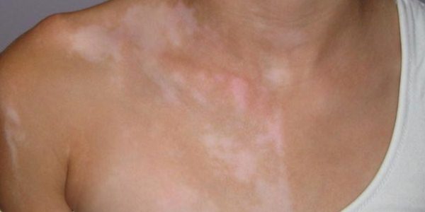 Причины появления и методы лечения пятен белого цвета на коже