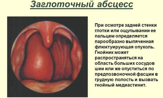 Заглоточный абсцесс