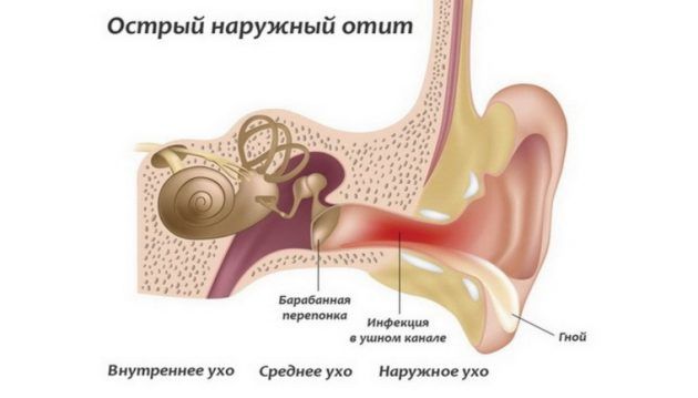 Острый наружный отит