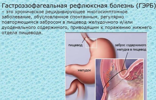 Гастроэзофагеальная рефлюксная болезнь