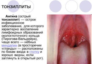 Острый тонзиллит